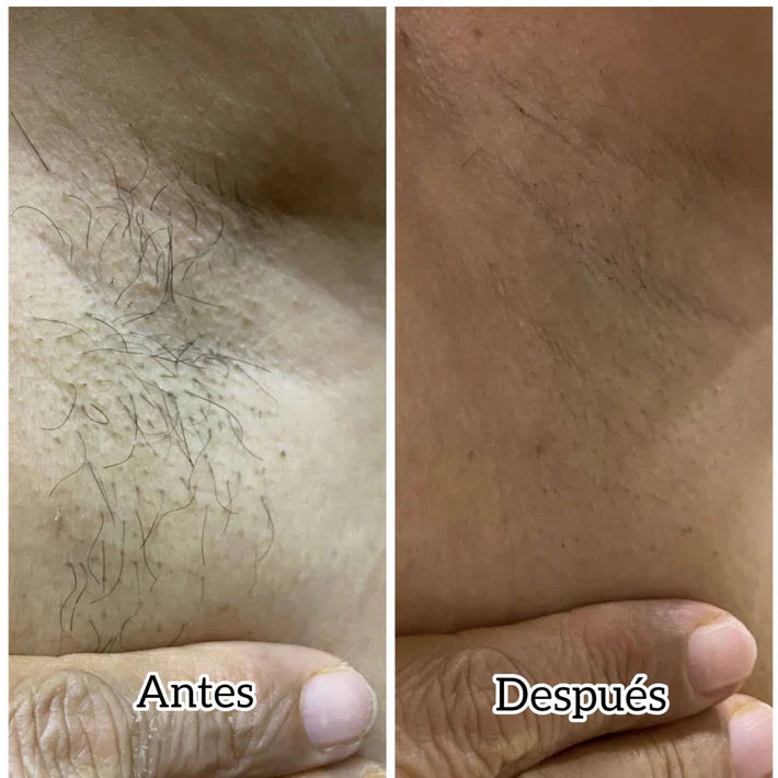 Depiladora Healovia®