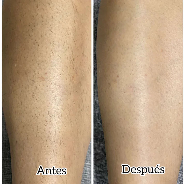 Depiladora Healovia®