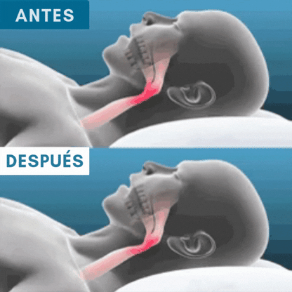 Znorex® Protector Bucal Anti-Ronquidos